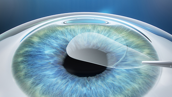 신개념 시력교정수술 TFC 스마일 가능