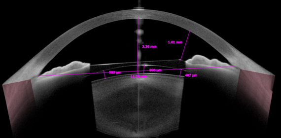 ICL 수술 후 vaulting