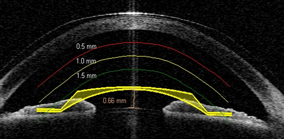 눈의 구조적 변화에 따른 렌즈 안전 거리 예측