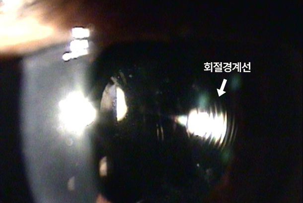 인공수정체의 종류별 특이성과 한계