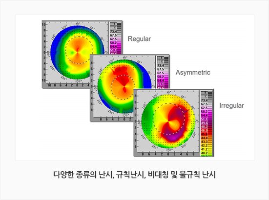 다양한 종류의 난시, 규칙난시, 비대칭 및 불규칙 난시