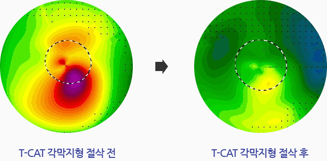 T-CAT 각막지형 절삭 전, T-CAT 각막지형 절삭 후