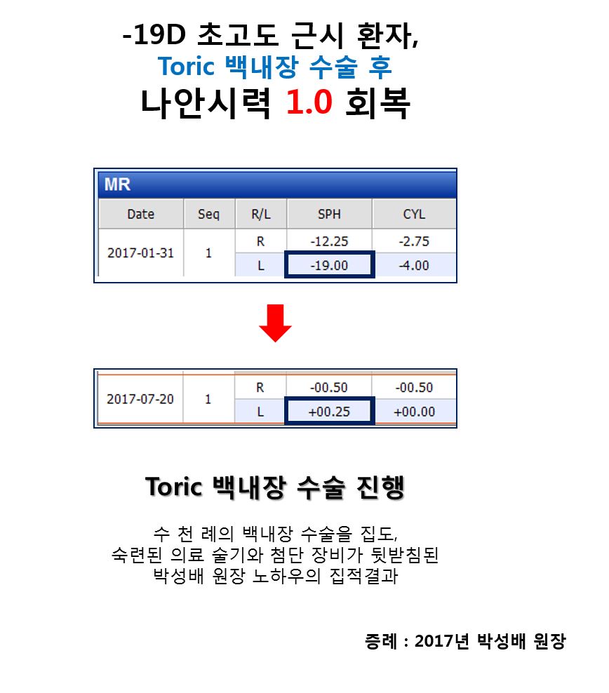 [수연세 증례] -19D 초고도 근시 환자, Toric 백내장 수술 증례_박성배 원장