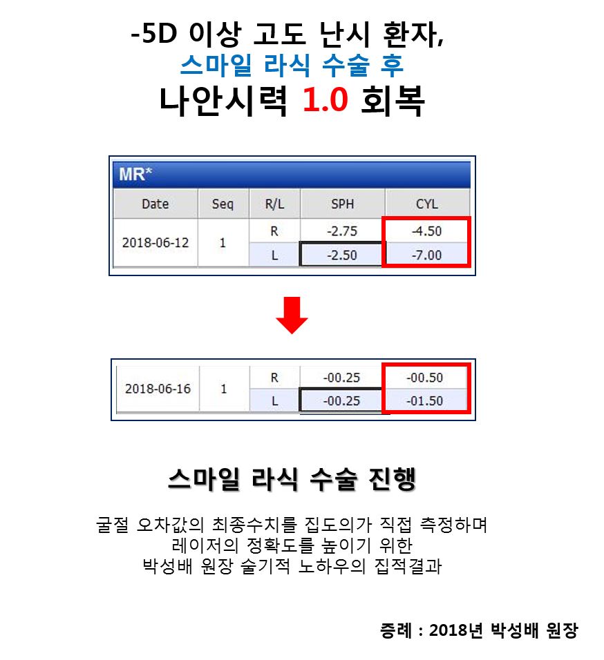 [수연세 증례] -5D 이상 고도 난시 환자, 스마일라식 수술 증례 - 박성배 원장
