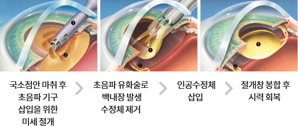 수술과정