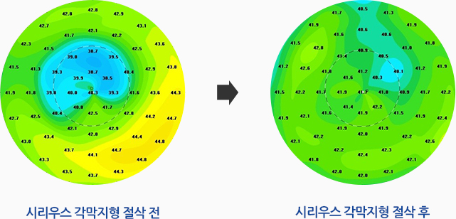 시리우스 각막지형 절삭 전, 시리우스 각막지형 절삭 후