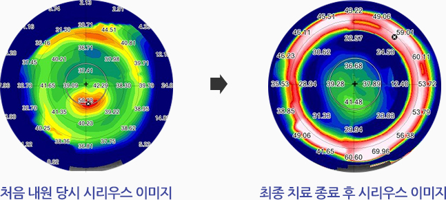 처음 내원 당시 시리우스 이미지, 최종 치료 종료 후 시리우스 이미지