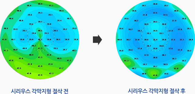 시리우스 각막지형 절삭 전, 시리우스 각막지형 절삭 후