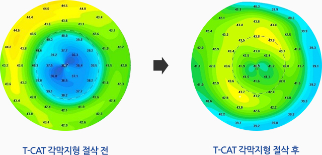 T-CAT 각막지형 절삭 전, T-CAT 각막지형 절삭 후