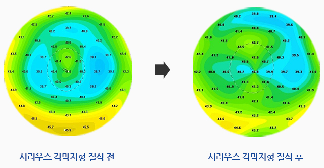 시리우스 각막지형 절삭 전, 시리우스 각막지형 절삭 후