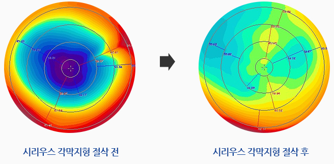 시리우스 각막지형 절삭 전, 시리우스 각막지형 절삭 후