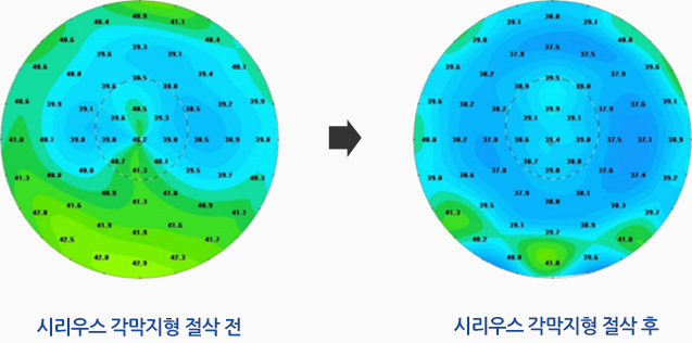 시리우스 각막지형 절삭 전, 시리우스 각막지형 절삭 후