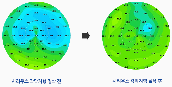 시리우스 각막지형 절삭 전, 시리우스 각막지형 절삭 후