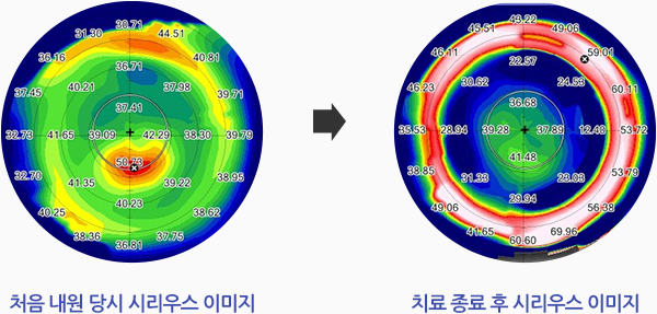 처음 내원 당시 시리우스 이미지, 최종 치료 종료 후 시리우스 이미지