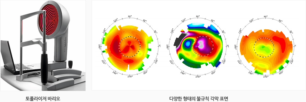 토폴라이저 바리오 / 다양한 형태의 불규칙 각막 표현