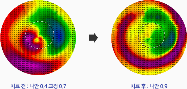 치료전 : 나안 0.4 교정 0.7 / 치료후 : 나안 0.9