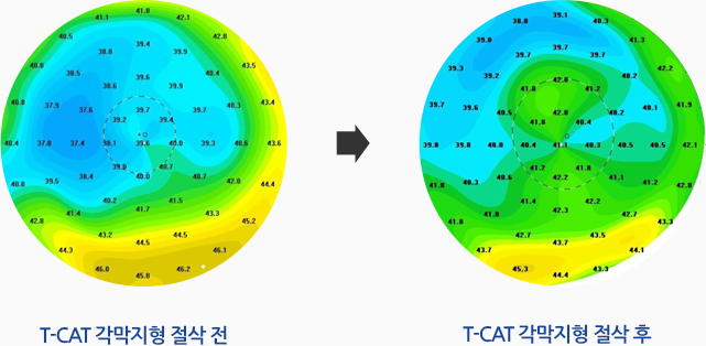 t-cat 각막지형 절삭 전 / t-cat 각막지형 절삭 후