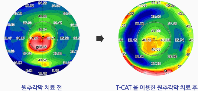 원추각막 치료전 / T-CAT 를 이용한 원추각막 치료 후