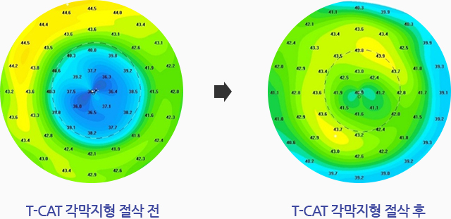 T-CAT 각막지형 절삭 전, T-CAT 각막지형 절삭 후