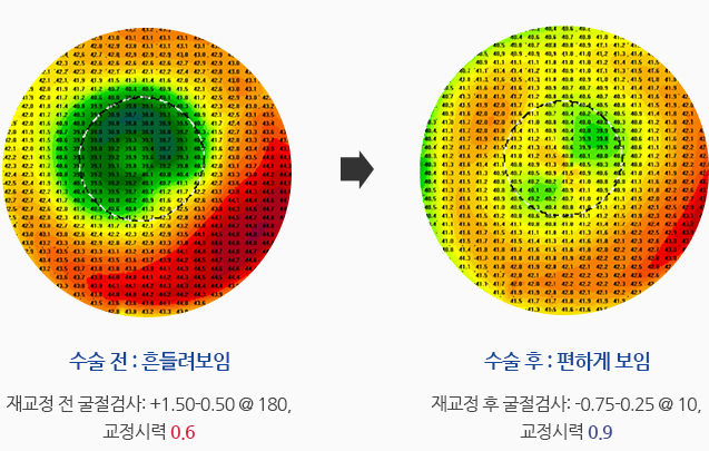 수술 전:흔들려보임 (재교정 전 굴절검사: +1.50-0.50@180.교정시력 0.6), 수술 후:편하게 보임 (재교정 후 굴절검사:-0.75-0.25@10.교정시력 0.9)