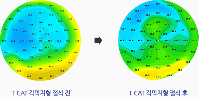 T-CAT 각막지형 절삭 전, T-CAT 각막지형 절삭 후