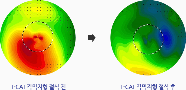 T-CAT 각막지형 절삭 전, T-CAT 각막지형 절삭 후