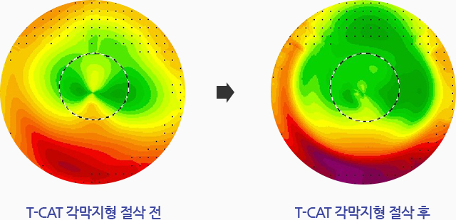 T-CAT 각막지형 절삭 전, T-CAT 각막지형 절삭 후