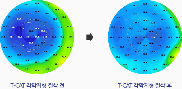 T-CAT 각막지형 절삭 전, T-CAT 각막지형 절삭 후