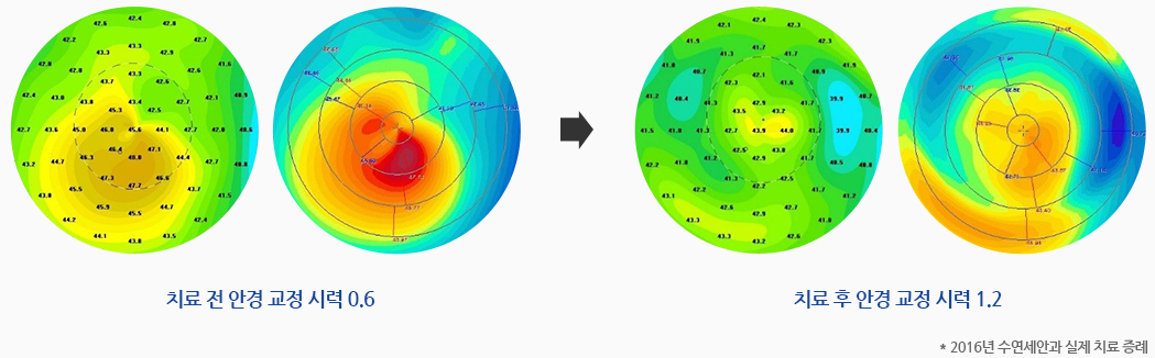 치료 전 안경 교정 시력 0.6, 치료 후 안경 교정 시력 1.2   * 2016년 수연세안과 실제 치료 증례