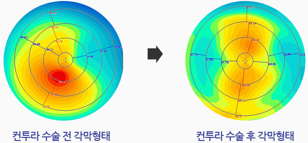 원추각막