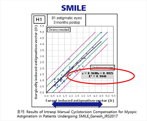 더 정확해진 난시교정효과 1