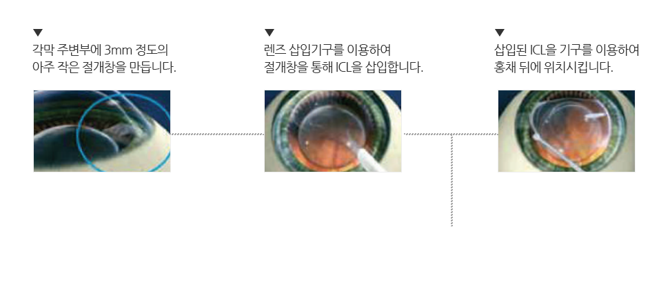 하루 만에 회복 가능!